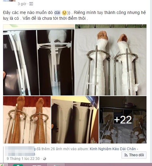 Mới đây, chàng trai Hà Nội có nickname Facebook Tùng Anh Hoàng gây "dậy sóng" cộng đồng mạng khi chia sẻ lên trang cá nhân kinh nghiệm kéo dài chân để cải thiện chiều cao của chính mình, từ 1m67 lên 1m76.